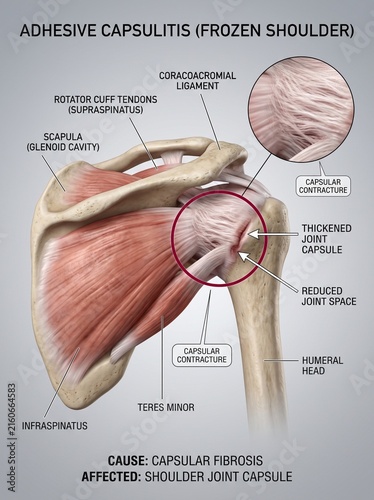 Adhesive Capsulitis or Frozen Shoulder Anatomical Diagram Showing Capsular Fibrosis and Joint Inflammation