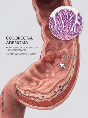 Colorectal Adenoma Medical Illustration Showing Adenomatous Polyp and Histology View