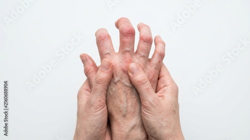 Close up of deformed hands with rheumatoid arthritis