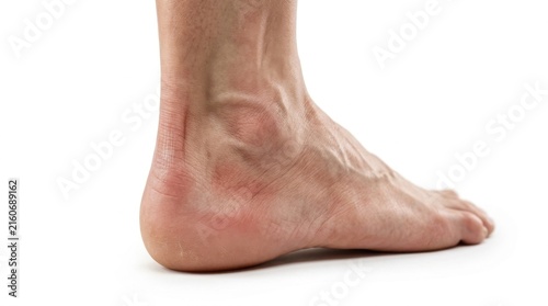 Human foot with red inflamed Achilles tendon and heel area