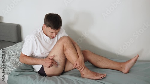 Man sitting on home bed applying pain relief cream to large thigh hematoma. Self treatment of leg after injury, recovery of skin and tissues with medicinal ointment, full body.