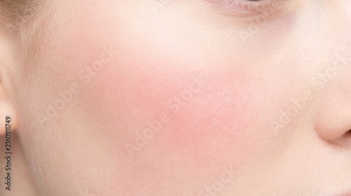 Soft close up of flushed pink cheek skin with subtle redness