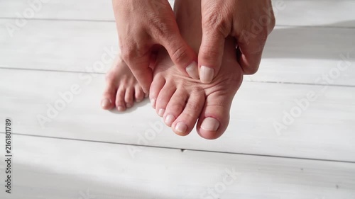 Female foot suffers from inflammation of the big toe bone. Hallux valgus, bunion in foot on white background. Close up