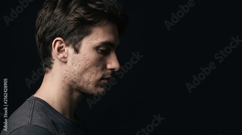 Profile portrait of young man with deep ice pick acne scars on cheek