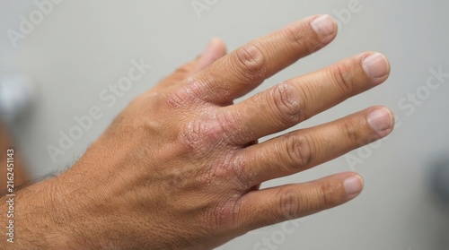 Close up of a human hand showing signs of skin irritation or dermatological condition