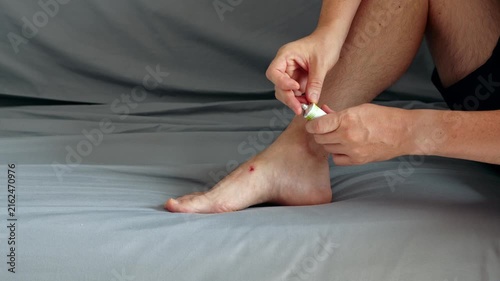 Person applying medicinal cream to a small skin injury on their ankle