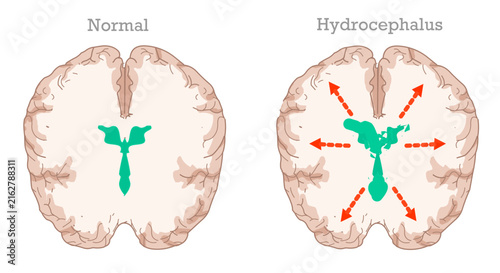 Hydrocephalus is a condition caused by the accumulation of cerebrospinal fluid in the brain. Cross section anatomy. Top view. Illustration vector 