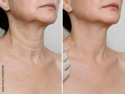 Before and after neck wrinkles reduction dermal filler biostimulator injection