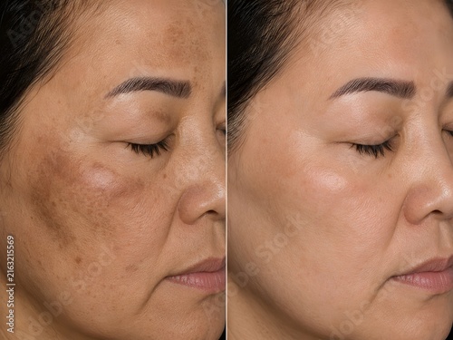 Before and after melasma pigmentation removal fractional CO2 laser treatment