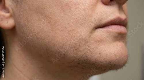 Woman's chin shows excess facial hair growth associated with hormonal imbalance or hirsutism.