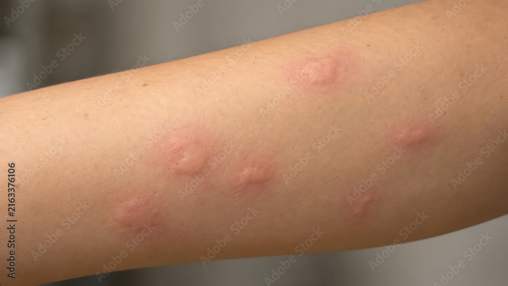 Fototapeta premium Close up of a forearm with multiple raised red welts and bumps, illustrating skin irritation, swelling, itching, allergic reaction, and dermatology symptoms.