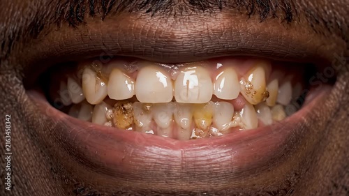 Close-up of man smiling with yellowed damaged teeth.