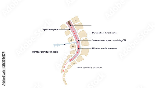 Foto Sagittal section  of spinal cord, Sagittal view showing the spinal cord, conus medullaris, filum terminale, and lumbar puncture site