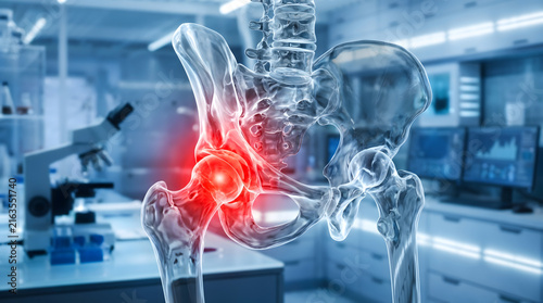 3D Rendered Medical Illustration of Human Hip Joint Anatomy Showing Painful Bone Injury in Red Highlight