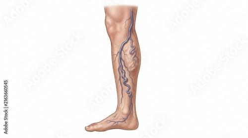 Medical Illustration of Varicose Veins on Human Leg Showing Swollen and Twisted Blue Veins Anatomy