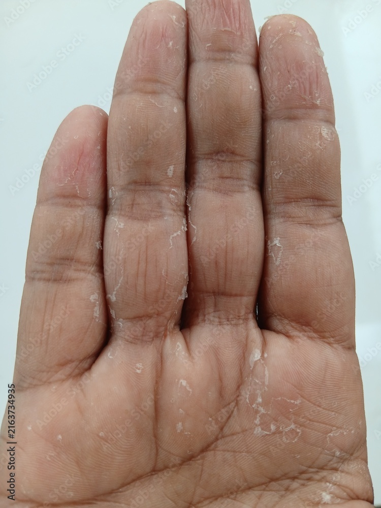 Fototapeta premium Close-up view of a hand with dry, flaky skin and peeling on the fingers and palm.
