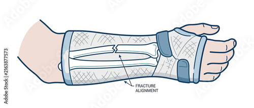 Bild auf Leinwand Broken Arm Bone Fracture with Medical Cast Illustration