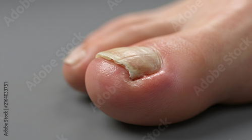 Ingrown toenail on a big toe
