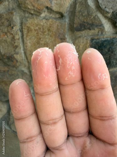 Fotografie Close-up of a hand with wrinkled, water-soaked fingers after prolonged exposure to water