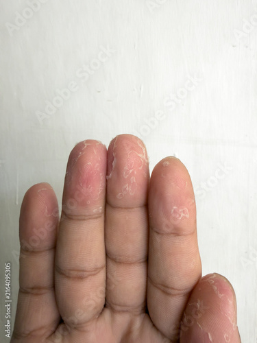 Foto Close-up of a persons fingers showing wrinkled skin after prolonged water exposure