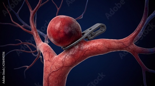 Detailed medical 3D rendering showing a surgical metallic clip applied to a brain aneurysm on a red blood vessel branch for neurosurgery treatment procedure