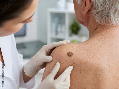 Dermatologist examining a suspicious dark mole on a senior patient's back during a skin cancer screening.
