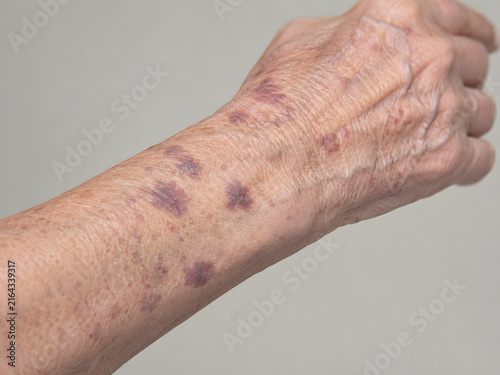 Close up of an elderly person's arm covered in dark bruises and spots, indicating senile purpura.