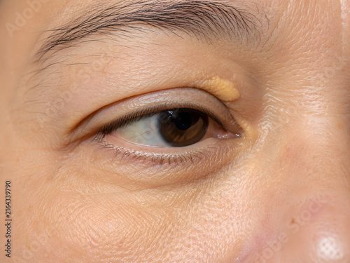Close up of a woman's eye with Xanthelasma, yellowish cholesterol deposits on the eyelid.