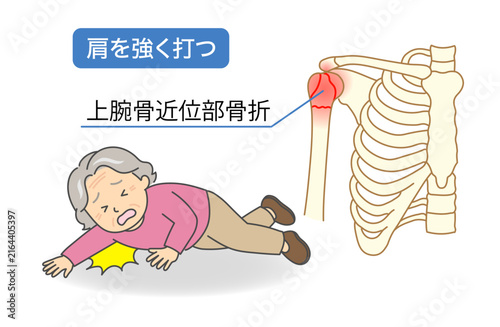 Bild auf Leinwand 転倒して肩を打ったおばあさんと骨折した上腕骨近位部のイラスト