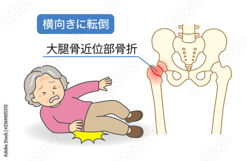 Bild auf Leinwand 横向きに転倒したおばあさんと大腿骨近位部骨折のイラスト