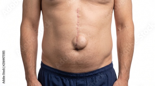 Adult Patient with Incisional Hernia Following Previous Abdominal Surgery