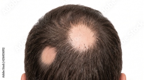 Adult Scalp with Alopecia Areata Showing Localized Hair Loss