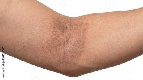 Adult Elbow Showing Atopic Dermatitis with Dry Inflamed Skin