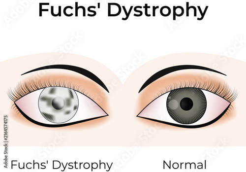 Foto Eye Condition Comparison with Normal Cornea Vector