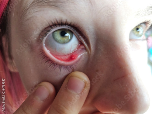 Obraz na plátně Eye irritation, stye, and pimple