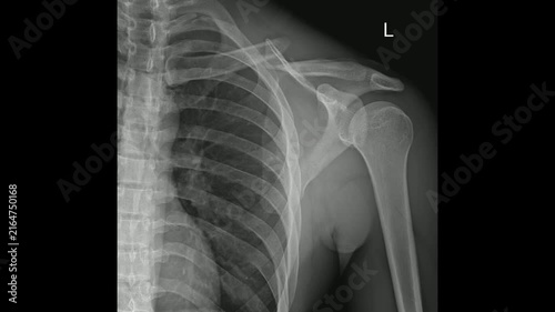 Left Clavicle X-ray Showing Midshaft Clavicle Fracture