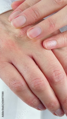 Skin irritation on female hands with visible redness and dryness. Close-up shows hand examination and personal care routine, highlighting sensitive skin, dermatology and wellness.