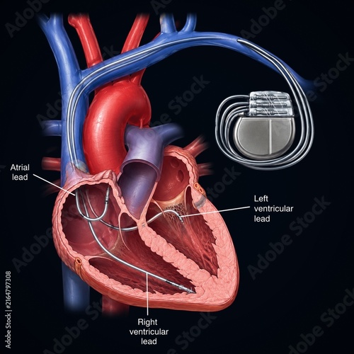Photography Medical diagram of biventricular CRT pacemaker with atrial and ventricular leads