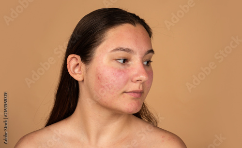 Принти на полотні Redness treatment for sensitive facial skin