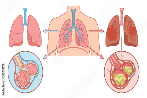 Educational medical infographic showing healthy and pneumonia-affected alveoli, highlighting inflammation, fluid buildup, reduced gas exchange, and respiratory complications