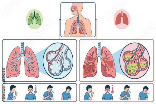 Detailed medical illustration depicting pneumonia-related alveolar inflammation, showing damaged air sacs, fluid accumulation, disrupted oxygen exchange, and respiratory impairment.