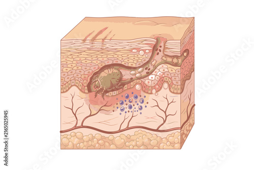 Educational medical infographic depicting Sarcoptes scabiei penetrating the epidermal layer and creating characteristic burrows associated with human scabies infection.