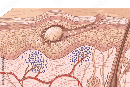 Detailed scientific illustration showing a scabies mite within the epidermis, highlighting burrow formation, parasite movement, and associated skin infestation.