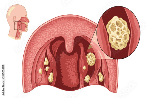Educational medical infographic depicting tonsilloliths within tonsil crypts, illustrating trapped debris, bacterial growth, mineralization, and associated oral health concerns.