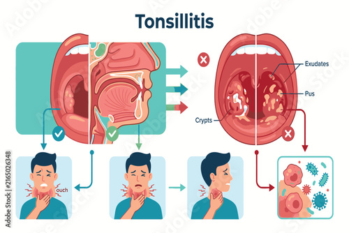 Detailed medical comparison showing healthy tonsils alongside tonsillitis, emphasizing anatomical changes, inflammation, infection, swelling, and visible clinical symptoms.