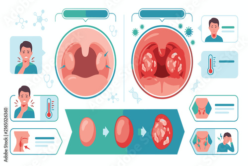 Professional healthcare infographic comparing healthy and inflamed tonsils, focusing on swelling, redness, infection indicators, symptoms, and essential throat anatomy.