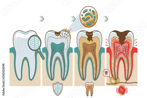 Detailed anatomical illustration showing the progression of dental caries through enamel and dentin toward the pulp, emphasizing structural damage and infection.