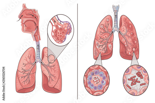 Medical infographic comparing healthy lungs and tuberculosis-infected lungs, highlighting bacterial infection, lung lesions, inflammation, and respiratory changes.