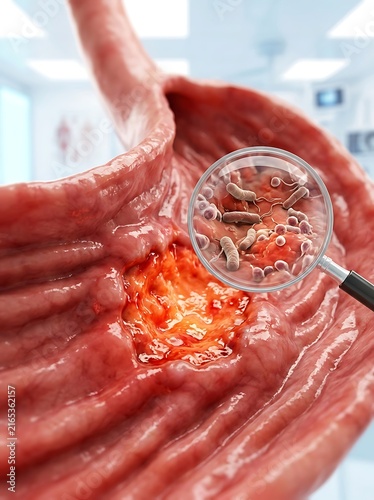 3d medical illustration of a stomach ulcer showing helicobacter pylori bacteria infection under a magnifying glass