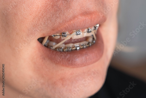 Fotografía Close up of teeth with metal braces and orthodontic elastics inside an open mouth